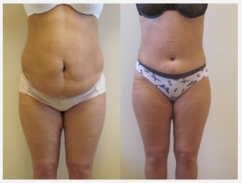 Prix abdominoplastie Tunisie