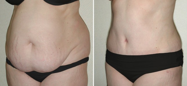 prix abdominoplastie en tunisie